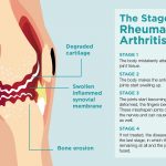 What Is Rheumatoid Arthritis?