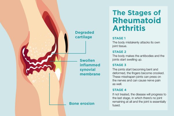 what is rheumatoid arthritis